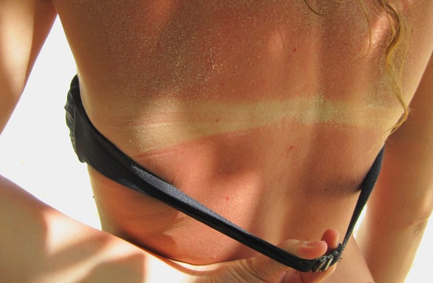 Pokožka si pamätá, koľko UV žiarenia dostala počas celého života. Aké zásady dodržiavať, aby bol pobyt na slnku bezpečný?￼