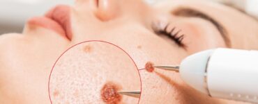 plastická chirurgia melanóm