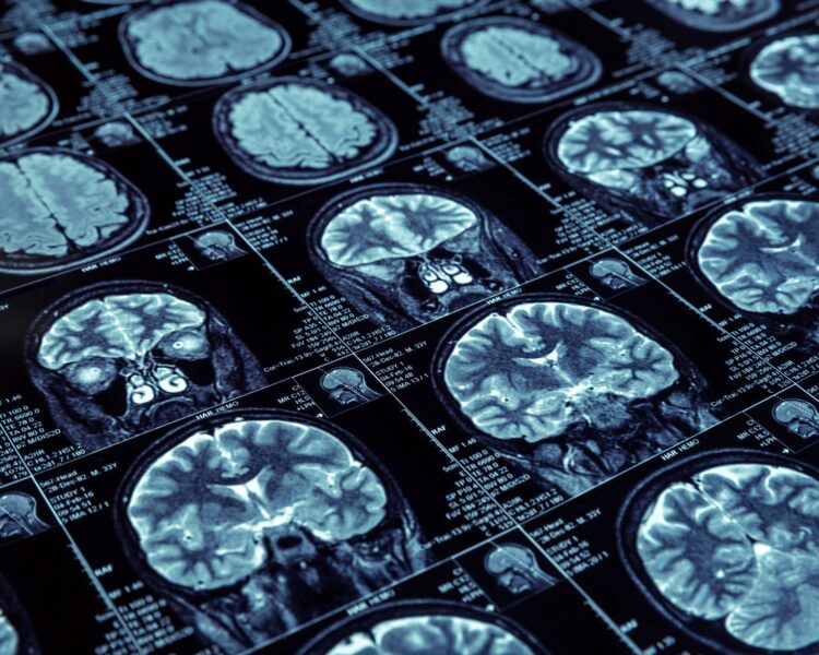 skleróza